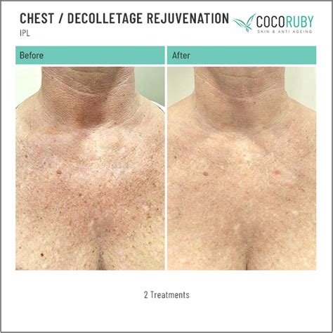 Skin Clinic Before And After Photos Coco Ruby Anti Ageing In Melbourne