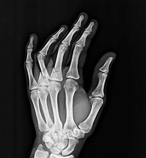 Hand Injuries -Xrays and Photographs | Bone and Spine
