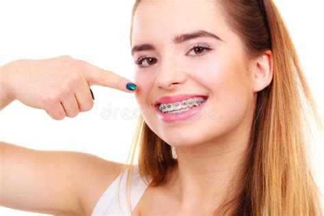 Woman Smiling Showing Teeth With Braces Stock Image Image Of Health Female 134332905