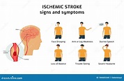 Ischemic Stroke Signs and Symptoms Infographic Flat Vector Illustration ...