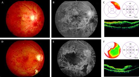 Macular Ischaemia After Intravitreal Bevacizumab Injection In Patients