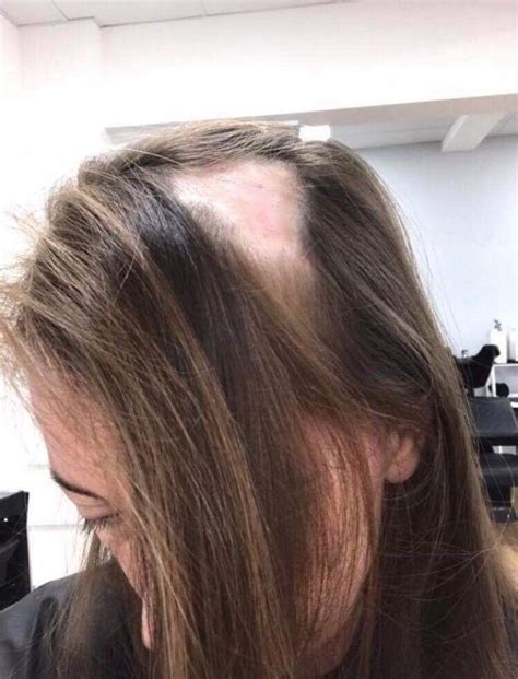 Solution To All Types Of Female Hair Loss And Thinning Hair In 2020