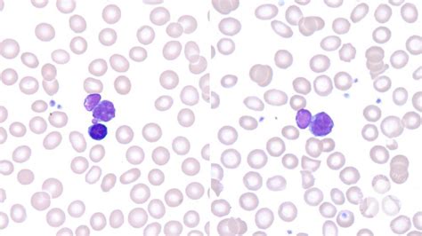 Peripheral Blood Smear 2019 Lymphoid Cells With Nuclear
