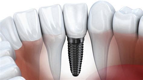 How To Use The X Rays In Dental Implant Identification By Vita