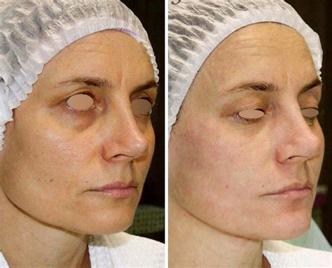 Thermage Before And After Facelift Info Prices Photos Reviews Q A