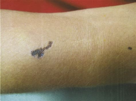 Black Spot Poison Ivy A Report Of 3 Cases With Clinicopathologic