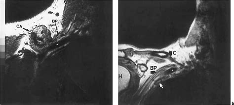 Figure 2 From Magnetic Resonance Imaging In Delayed Brachial Plexopathy