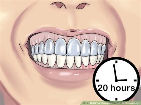 Find out how to straighten teeth with and without braces. Cum să obțineți dinți drepți fără bretele cu invizanțe ...