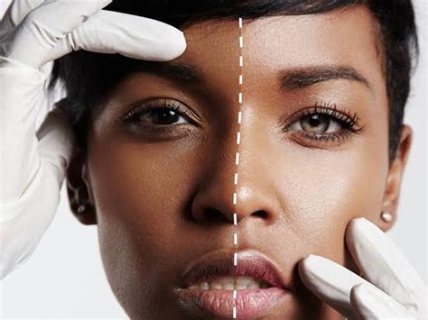 6 Negative Health Effects Of Bleaching Skin Health Guide Ng
