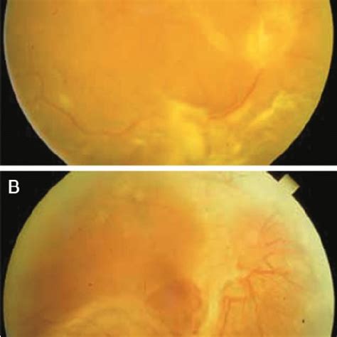Pdf Combined Rhegmatogenous And Traction Retinal Detachment In