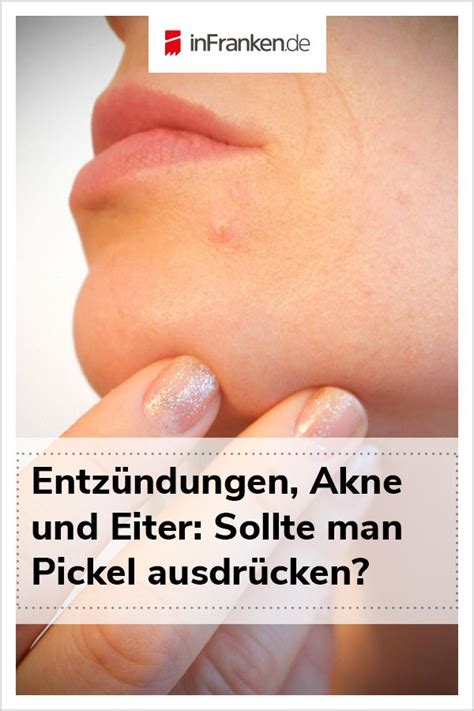 Und wer stand nicht schon einmal vor dem spiegel und hat. Pickel ausdrücken? Besser nicht! | Pickel ausdrücken ...