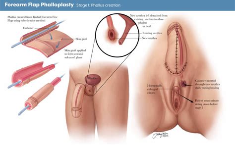 Phalloplasty For Gender Affirmation Johns Hopkins Medicine