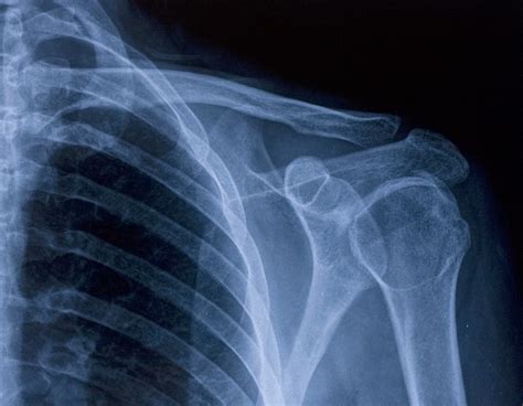 Broken Collar Bone X Rays