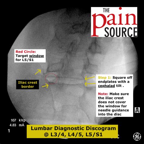 Lumbar Discogram Oblique View For Left Approach Of L5 S1 Disc The