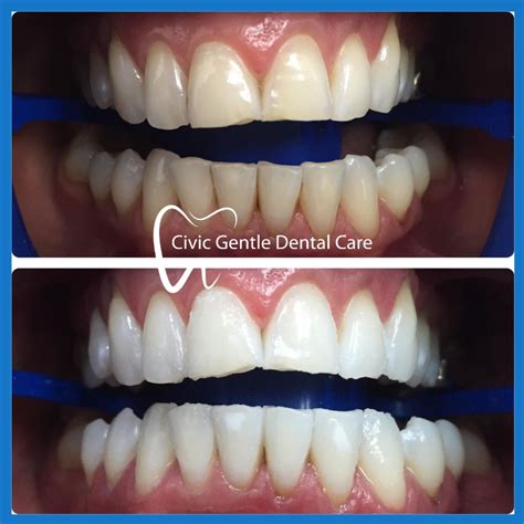 Canberra Teeth Whitening Specials Dentist Canberra