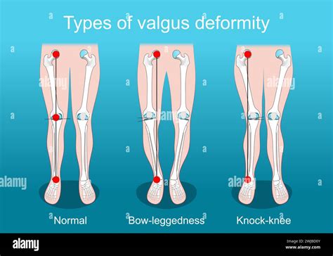 Deformities Ankle Stock Vector Images Alamy