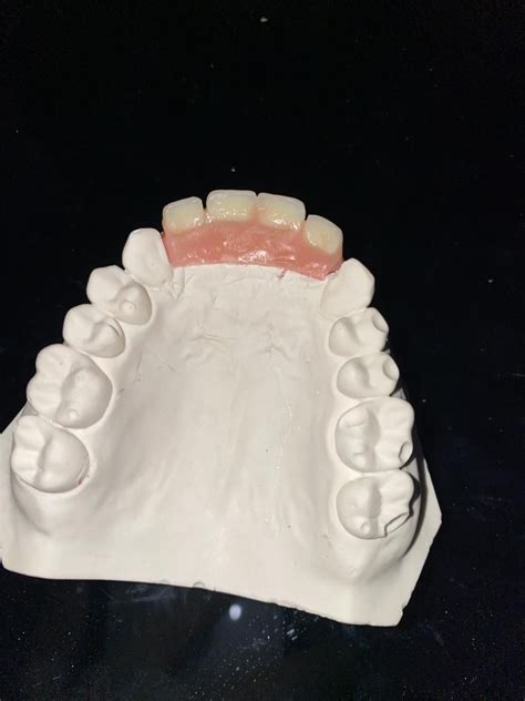 Diy dentures 285 views2 weeks ago. Do It Yourself Denture Kit Make Your Own Temporary Denture ...