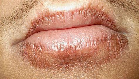 Sores On Lips Cracks Blisters Lumps Causes Healthhype Com