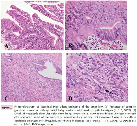 Carcinoma Of Ampulla Of Vater Carcinogenesis And Immunophenotyp