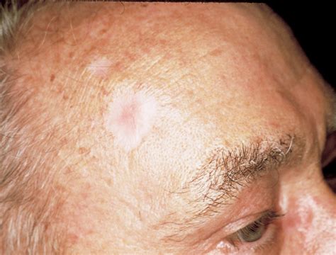 What Is Non Melanoma Skin Cancer Haleroadmedical