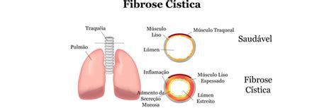 Fibrosis quística es una enfermedad que provoca la acumulación de moco espeso y pegajoso en los pulmones, el tubo digestivo y otras áreas del cuerpo. A Aplicação do Tratamento Fisioterapêutico na Fibrose Cística