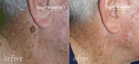 Laser Age Warts Removal Dr Peter Kim Surgery Skin Cancer Cosmetic