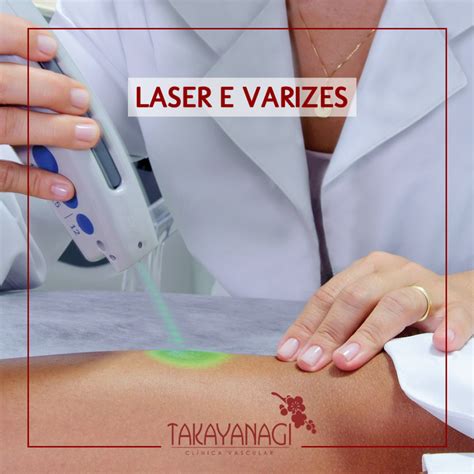 Laser E Varizes Clinica Takayanagi
