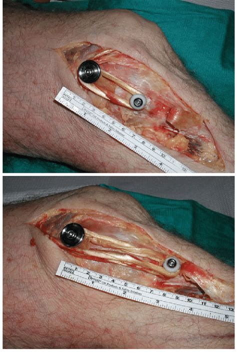Inflamed knee ligament at tendinite. MCL reconstruction with the graft length equal to the ...