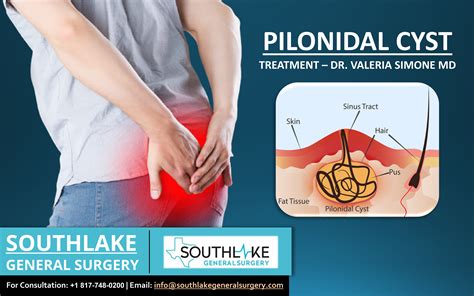 Will A Pilonidal Cyst Drain On Its Own Best Drain Photos Primagemorg