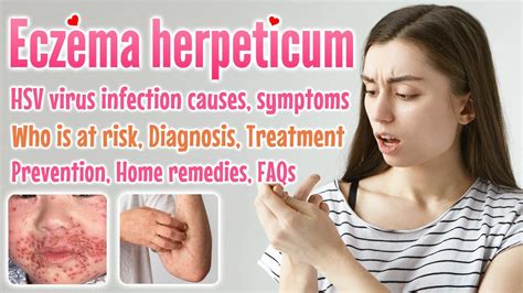 Eczema Herpeticum Overview Causes Symptoms Diagnosis Treatment