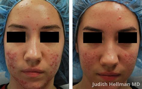 Best Acne Scars Treatment Nyc Hellman Dermatology