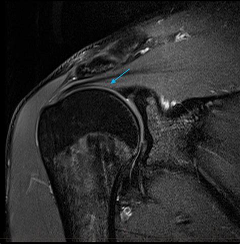 Mri Shoulder Normal Supraspinatus Tendon Mri At Melbourne Radiology