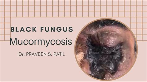 What Is Black Fungus Mucormycosis Youtube