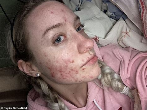 Woman Whose Acne Covered Every Inch Of Her Face In Deep Red Cysts