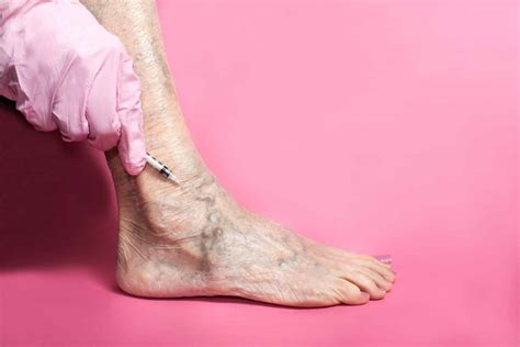 Sclerotherapy Treatment For Varicose Spider And Reticular Veins