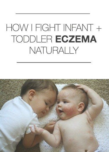 The Baby Eczema Lotion That Healed My Babys Skin Pig And Dac Toddler