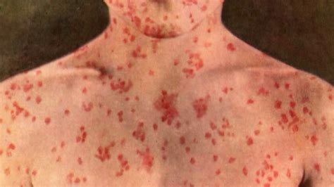 Measles Cases Reach Record High In Europe With Over 41000 People