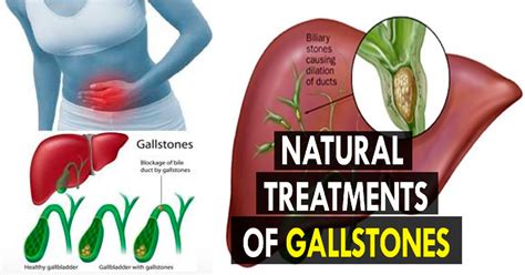 How Do You Get Stones In Your Gallbladder Gallstones Types Treatment