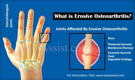 What Is Erosive Osteoarthritis And How Is It Treatedcauses Symptoms