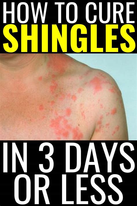 How To Cure Shingles In 3 Days Or Less Shingles Remedies Natural Treatments H