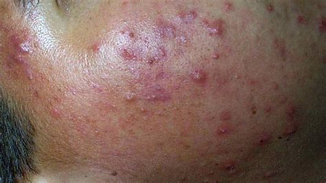 Noduläre Akne Symptome Behandlung Narbenbildung Und Mehr