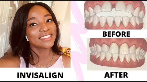 Invisalign Braces Before And After Gaps