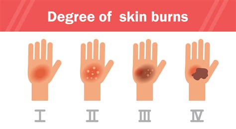 When To Seek Care For A Burn Hca Midwest Turn4thebetter