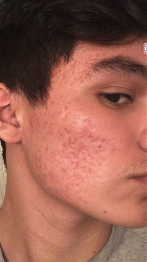 Severe Acne Scarring Scar Treatments