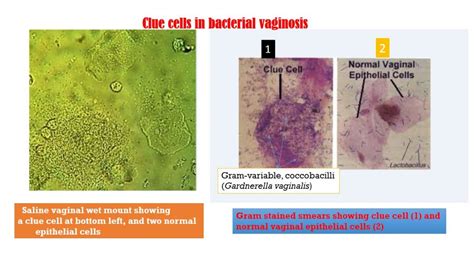 Bacterial Vaginosis Introduction Clue Cell Significance And Amsel Criteria