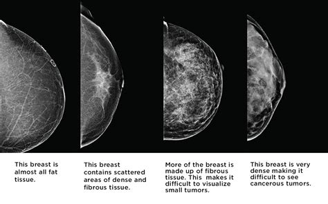 Mammogram Or Ultrasound Or Both Dr Zembroski