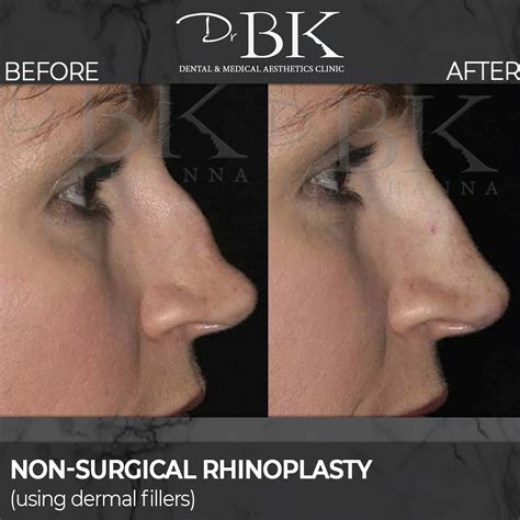 Non Surgical Rhinoplasty Drbk Award Winning Aesthetics Clinic