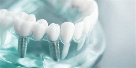 Tipos De Implantes Dentales Todo Lo Que Necesitas Saber Clinica
