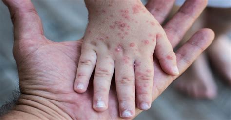 Us Measles Cases Are The Highest Since The Disease Was Eliminated In 2000
