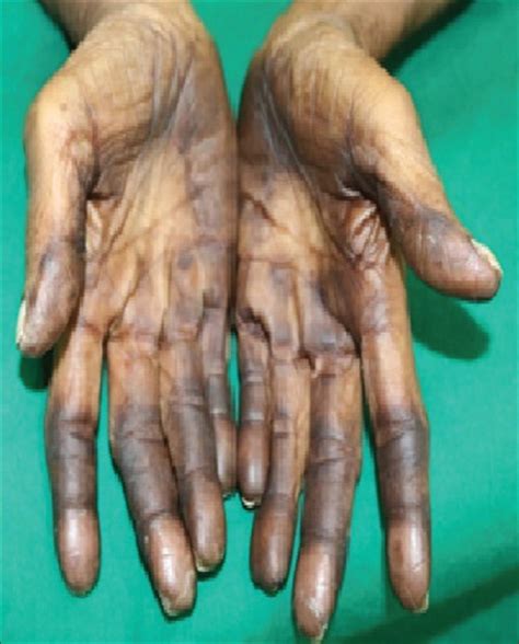 Involvement Of Scars In Capecitabine Induced Hand Foot Syndrome